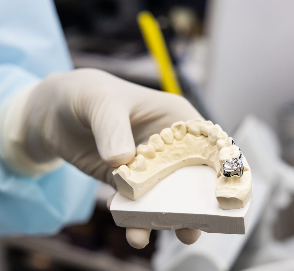 Dentist holding dental prosthesis imprint with metal crown on molar tooth