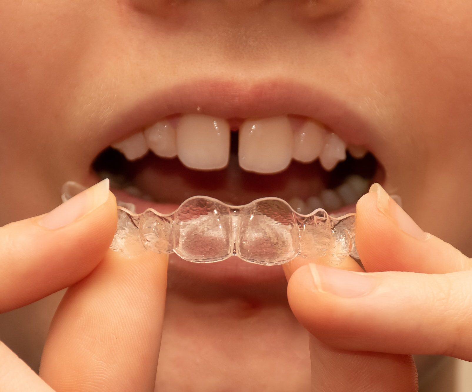 Girl put on Invisalign invisible braces. Bonded attachments on the teeth. Gap teeth
