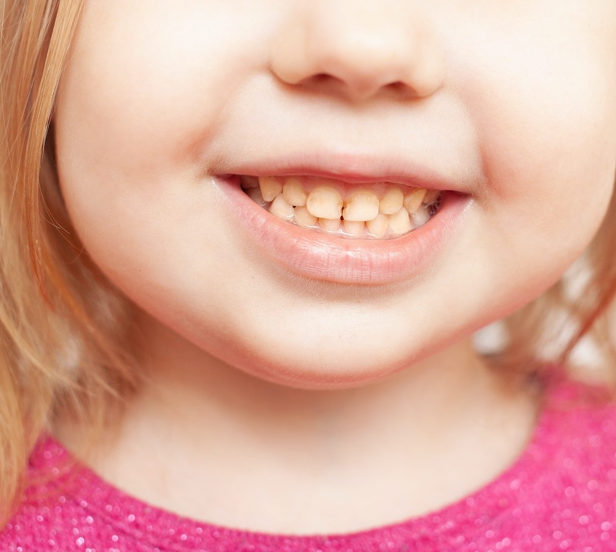 person smiles, shows teeth, yellow plaque, crooked teeth, malocclusion. childhood diseases